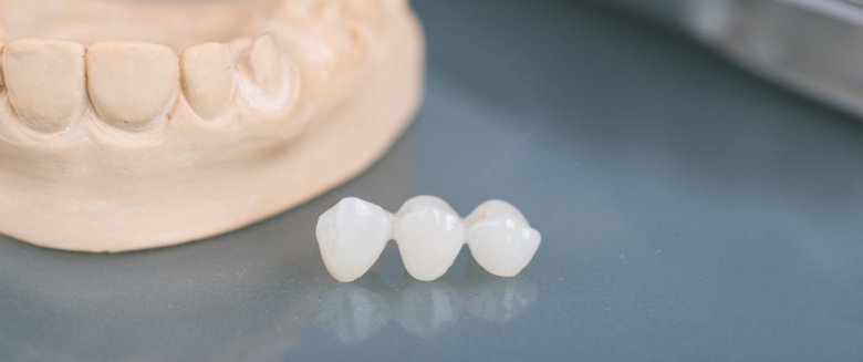 Dental bridge in Asheville on a reflective table