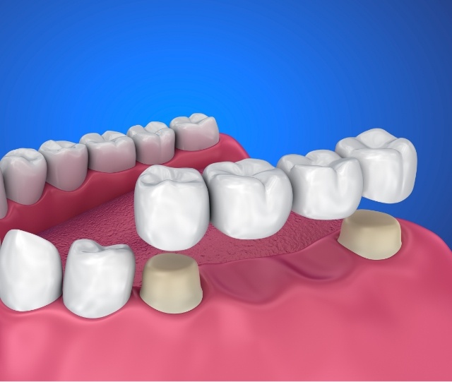 Illustration of dental crown being placed