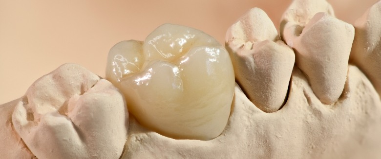 Close up of a dental crown in Asheville