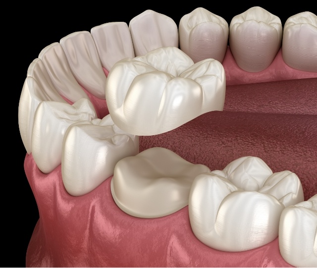 Illustration of dental crown being placed on tooth