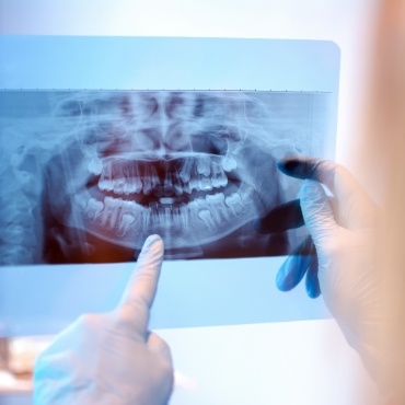 Pointing to a dental implant on a dental x ray