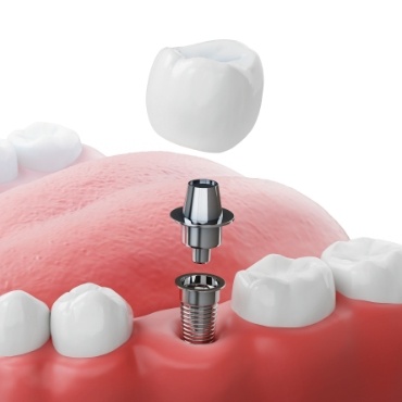 Illustration of a dental implant and a crown being placed