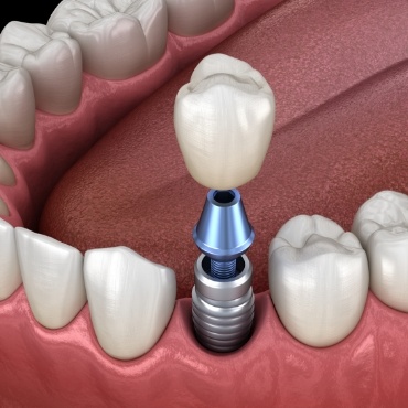 Illustration of a single dental implant