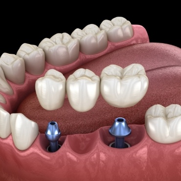 Illustration of dental bridge and two dental implants