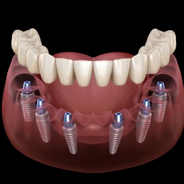 Dentures being attached to dental implants