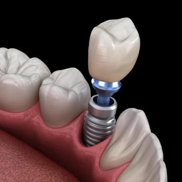 Illustration of crown being attached to dental implants