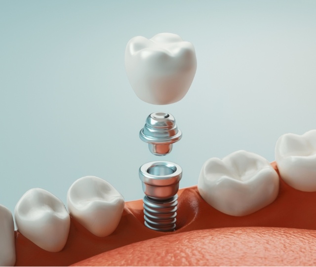 Illustration of dental implant being placed in lower jaw