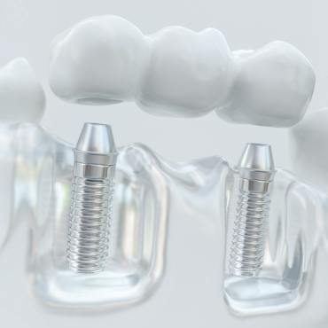 Dental bridge being attached to two dental implants in plastic tray