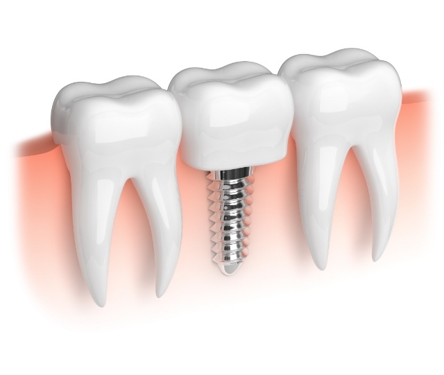 Illustration of dental implant between natural teeth