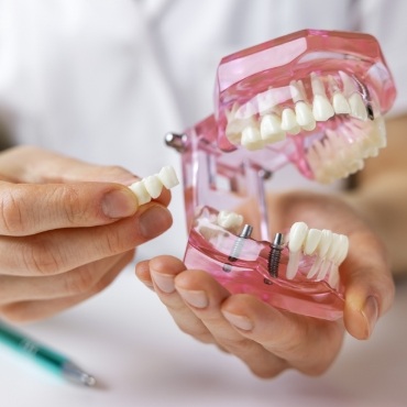 Holding a bridge and a model of mouth with dental implants