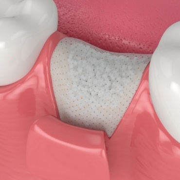 Illustration of jaw after bone grafting