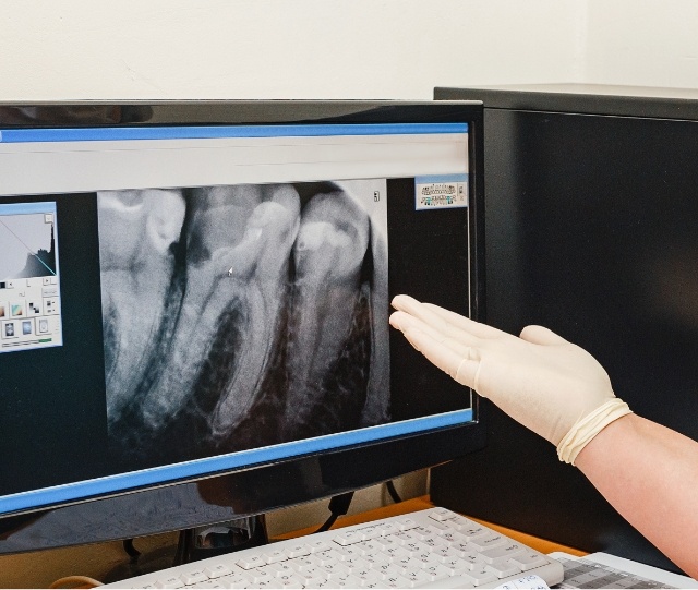 Digital dental x ray on a computer monitor