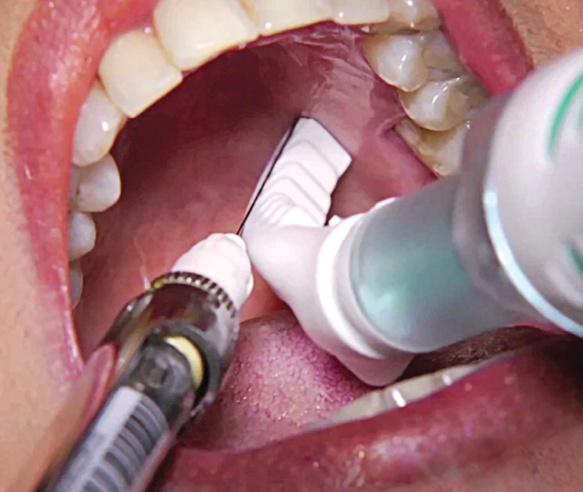 DentalVibe being used on mouth of patient