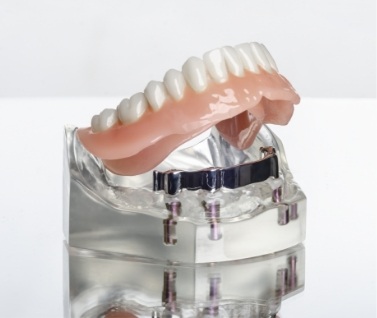 Model of implant dentures on clear stand