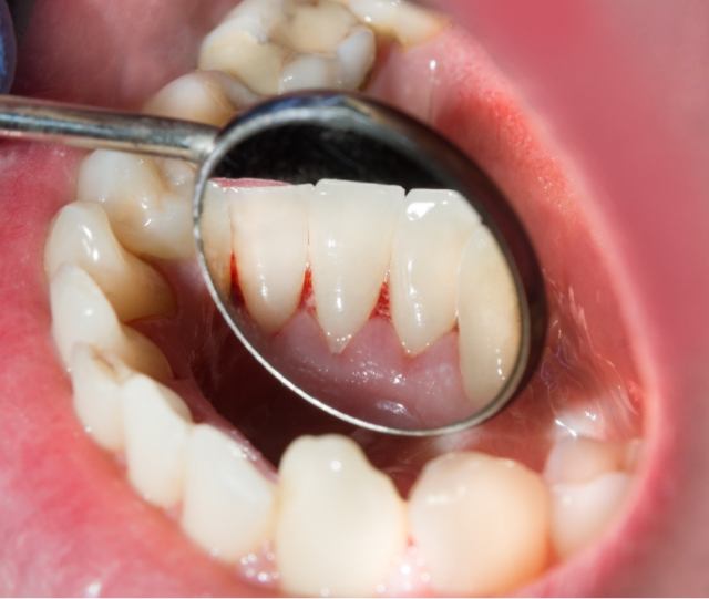 Examining red gums with a dental mirror