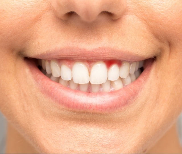 Close up of smile with inflamed gums