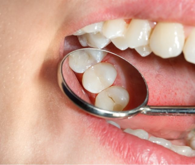 Dental mirror showing teeth after restorative dentistry in Asheville