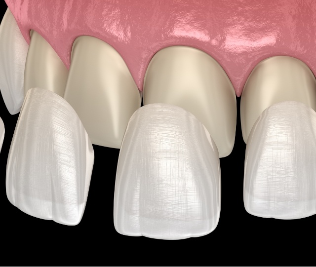 Veneers being placed on teeth in upper arch