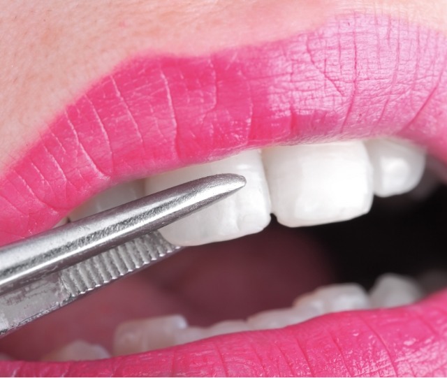 Close up of veneer being attached to front tooth